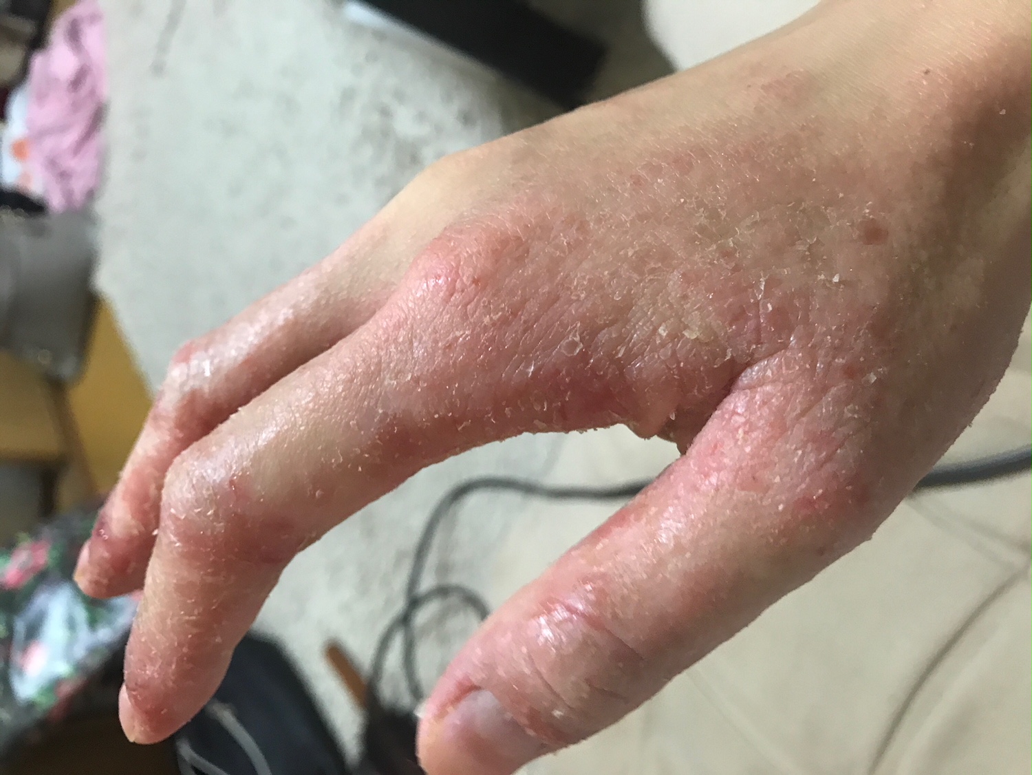 アトピー系の手もお辛い方で、施術前 アトピー系の手もお辛い方で、施術前