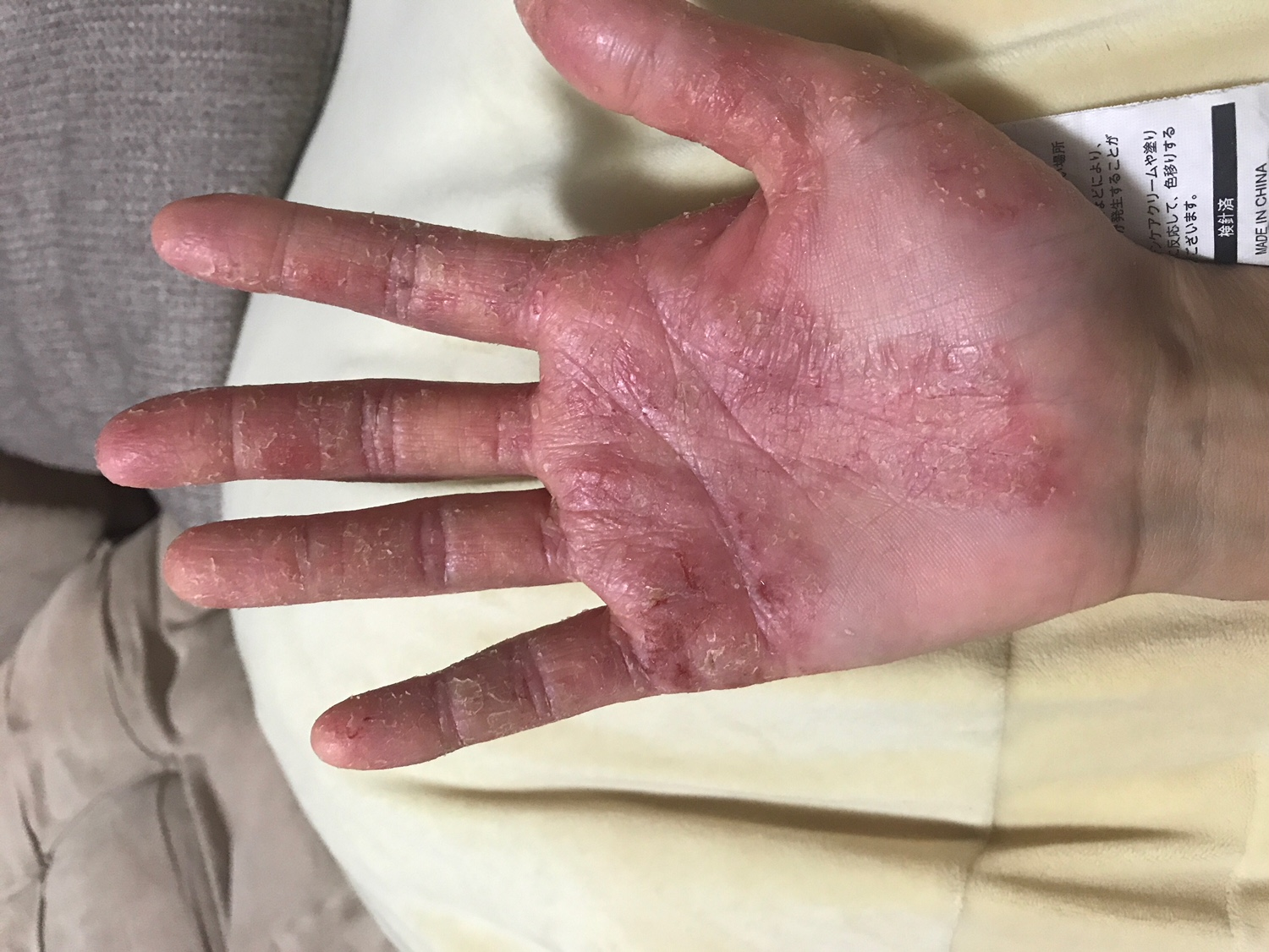 アトピー系の手もお辛い方で、施術前 アトピー系の手もお辛い方で、施術前