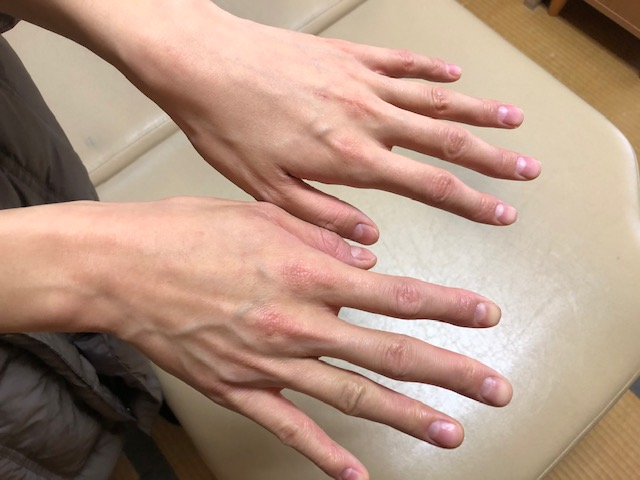 アトピー系の手もお辛い方で、施術後 アトピー系の手もお辛い方で、施術後