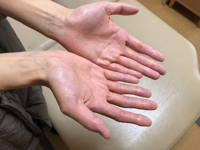 アトピー系の手もお辛い方で、施術後 アトピー系の手もお辛い方で、施術後